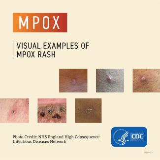 mpox poster 2